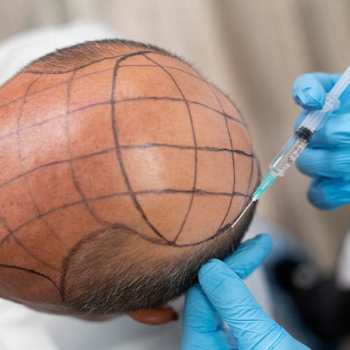 Hair Transplantation Clinic