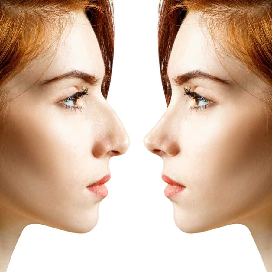 rhinoplasty