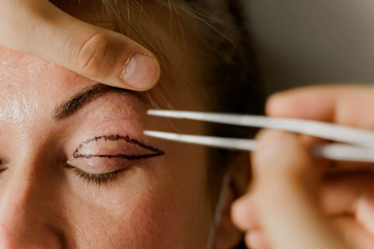 Blepharoplasty