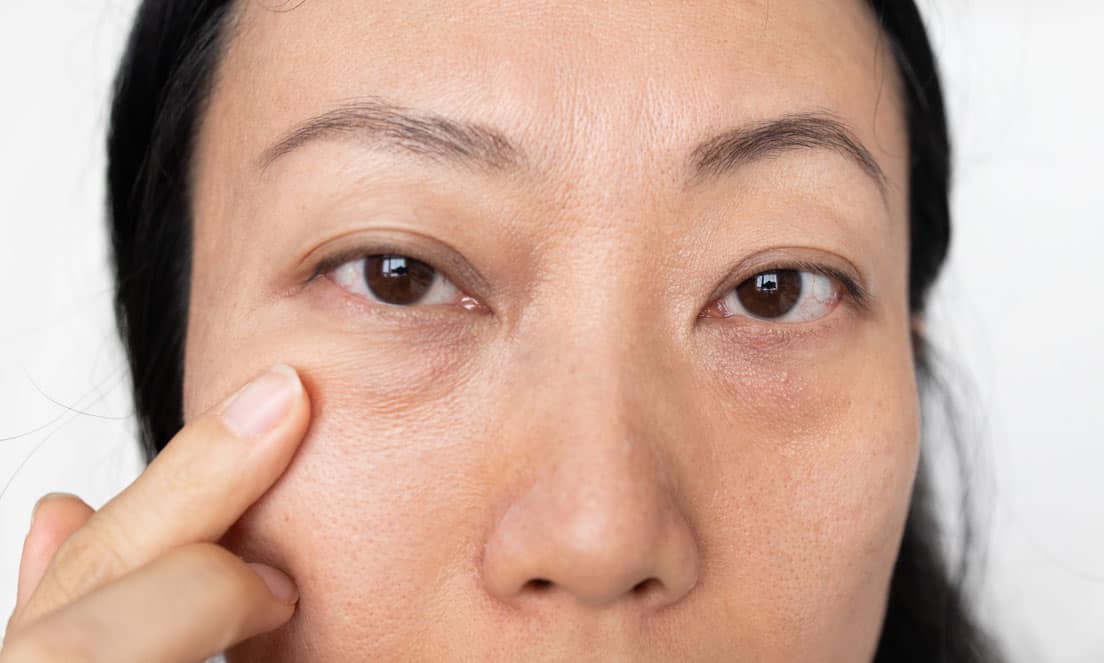 Blepharoplasty