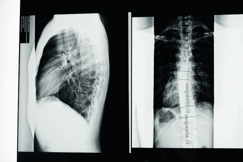 xray