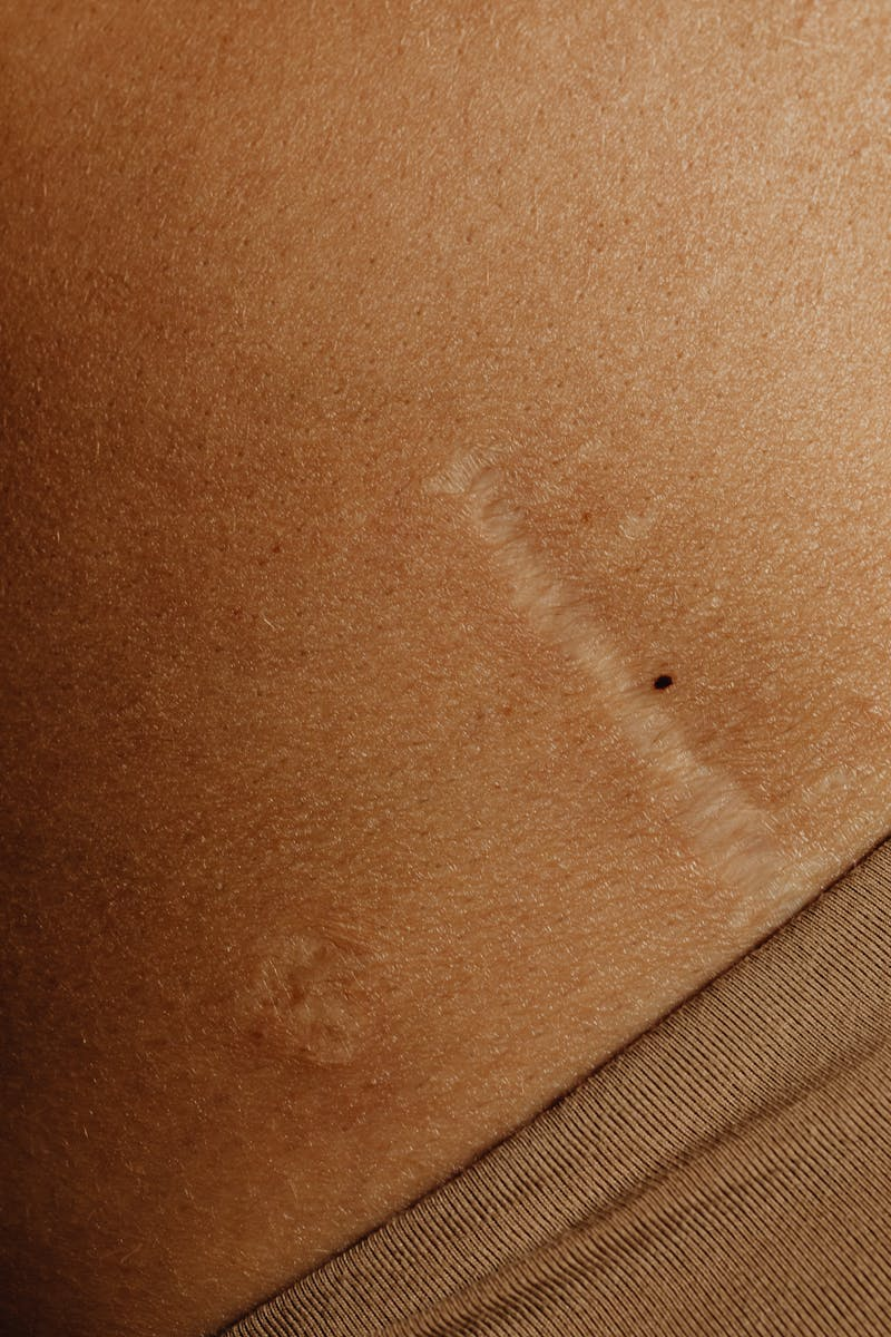 Scarring