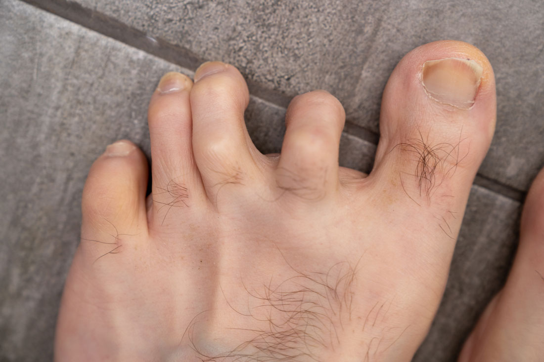Hammertoe