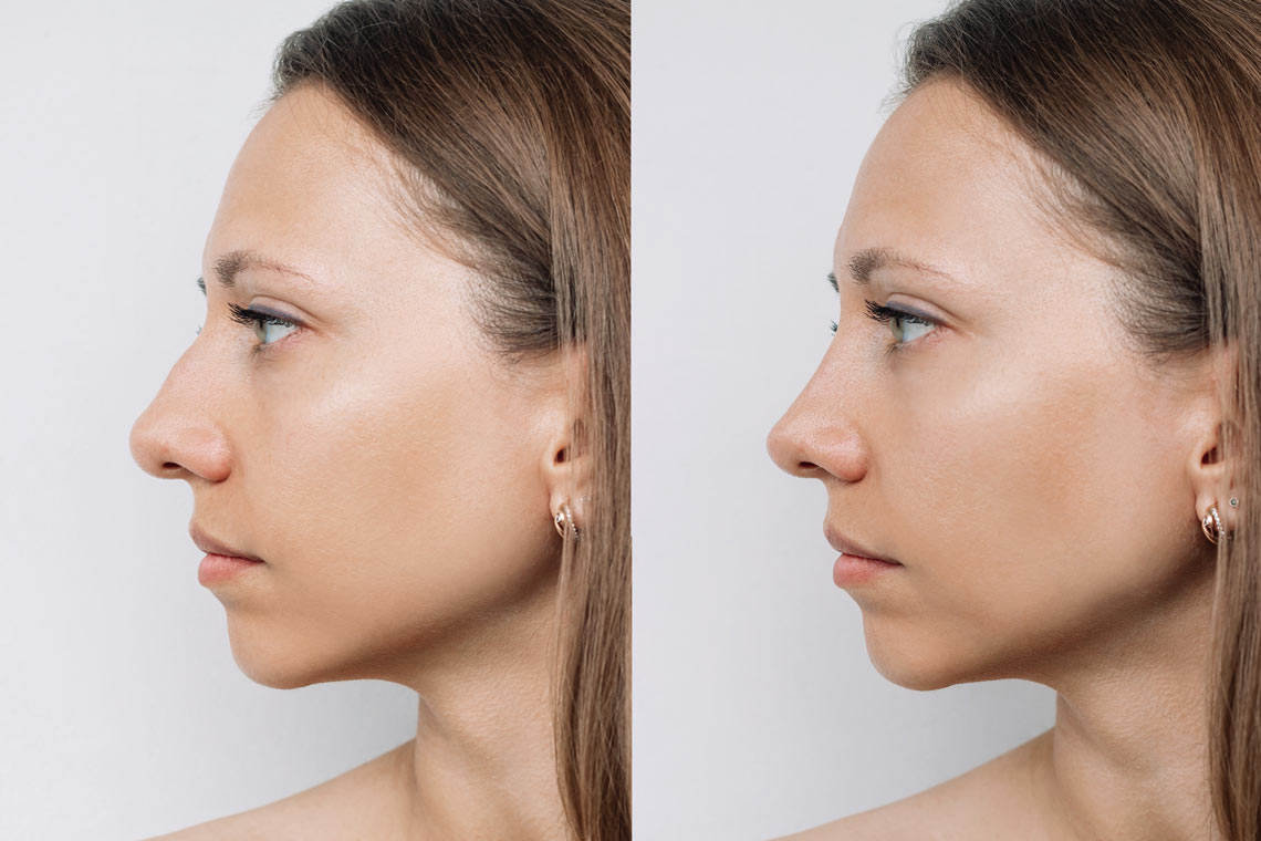 Rhinoplasty