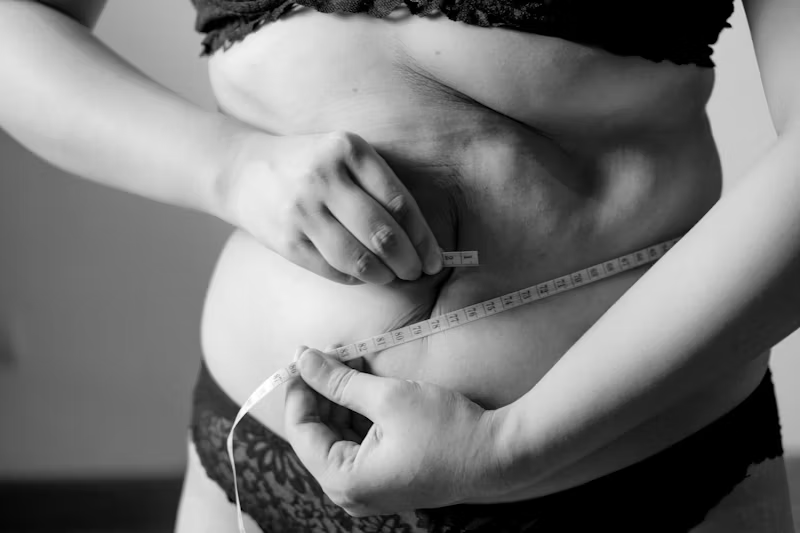Weight loss surgery